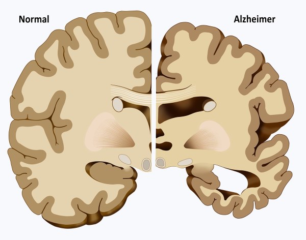 Normal VS Alzheimer Cerebro