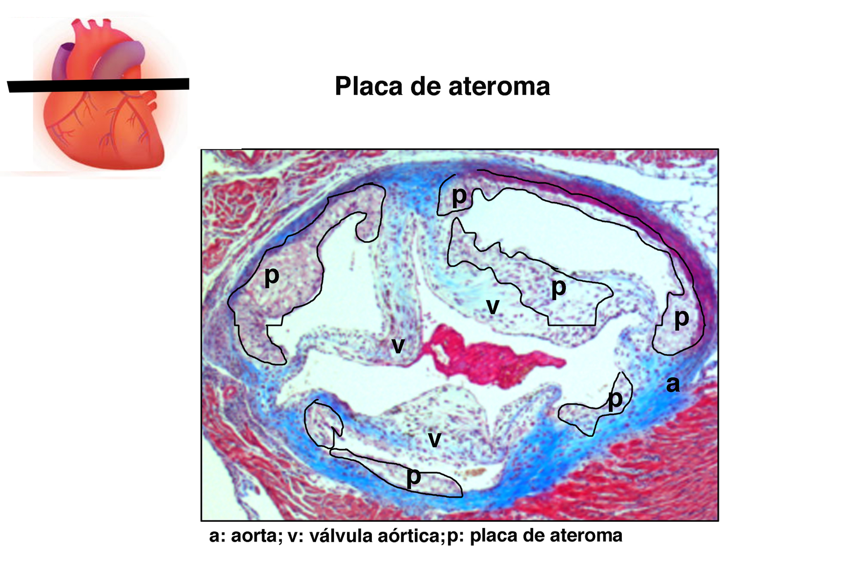 Placas de ateroma en la válvula aórtica Placas de ateroma en la válvula aórtica