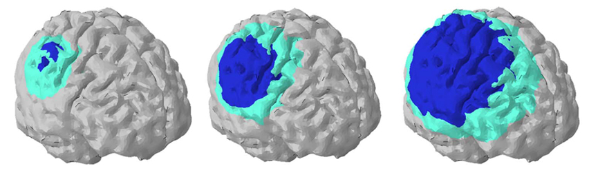 Modelo de daños cerebrales ante diferentes impactos Modelo de daños cerebrales ante diferentes impactos